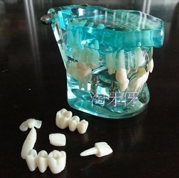 Blue Transparent Dental Implant Study Analysis Demonstration Teeth Model with Removable Teeth