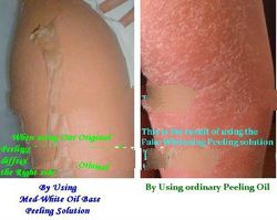New Med-White Oil Base Peeling Solution