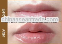 Lip enhance filler-hyaluronic Acid gel